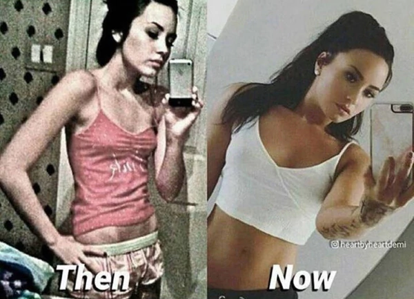 El antes y después de Demi Lovato tras su bulimia