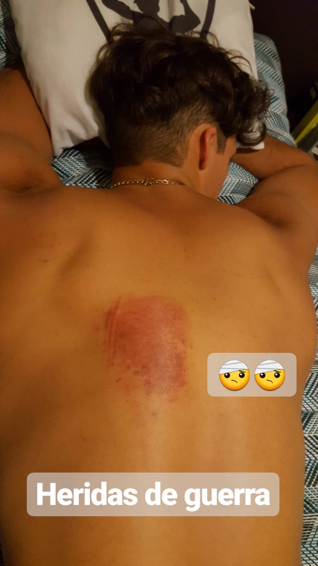 Patricio Parodi sufrió fuerte golpe en la espalda